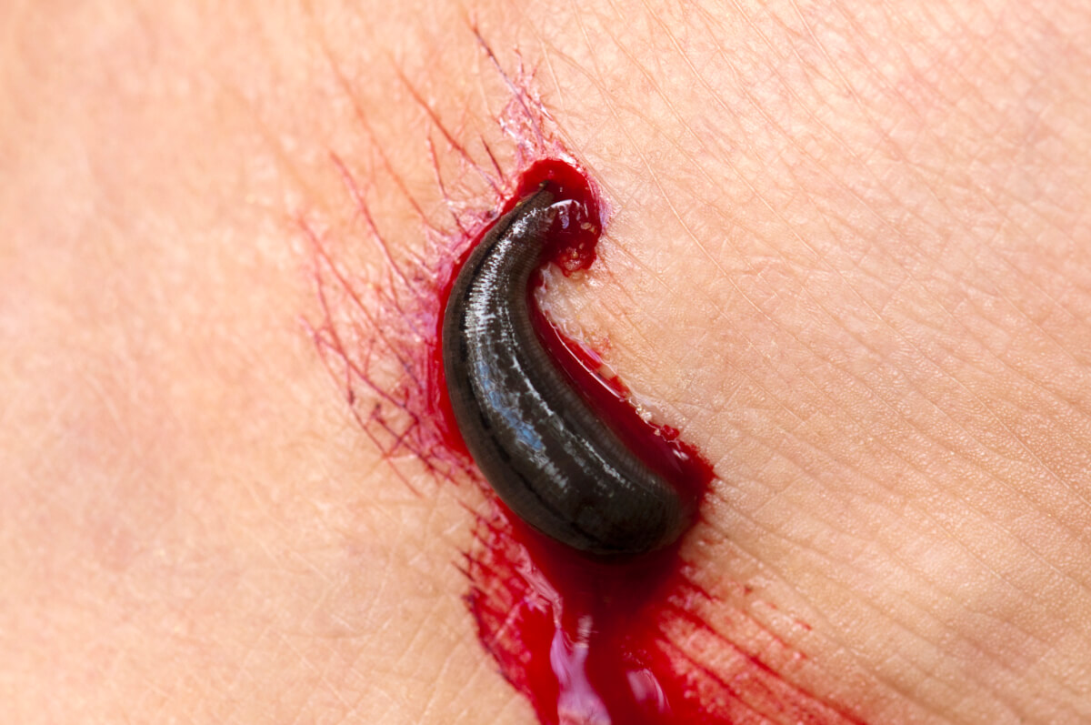 DON’T Suck it Up: How to Properly Remove Leeches