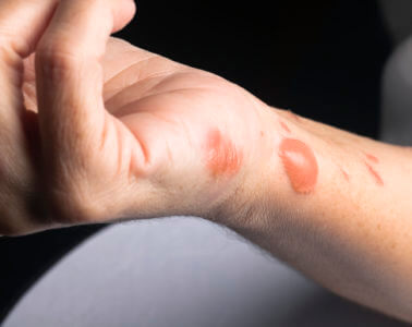 Hot Spot Healing: How to Treat Minor Burns