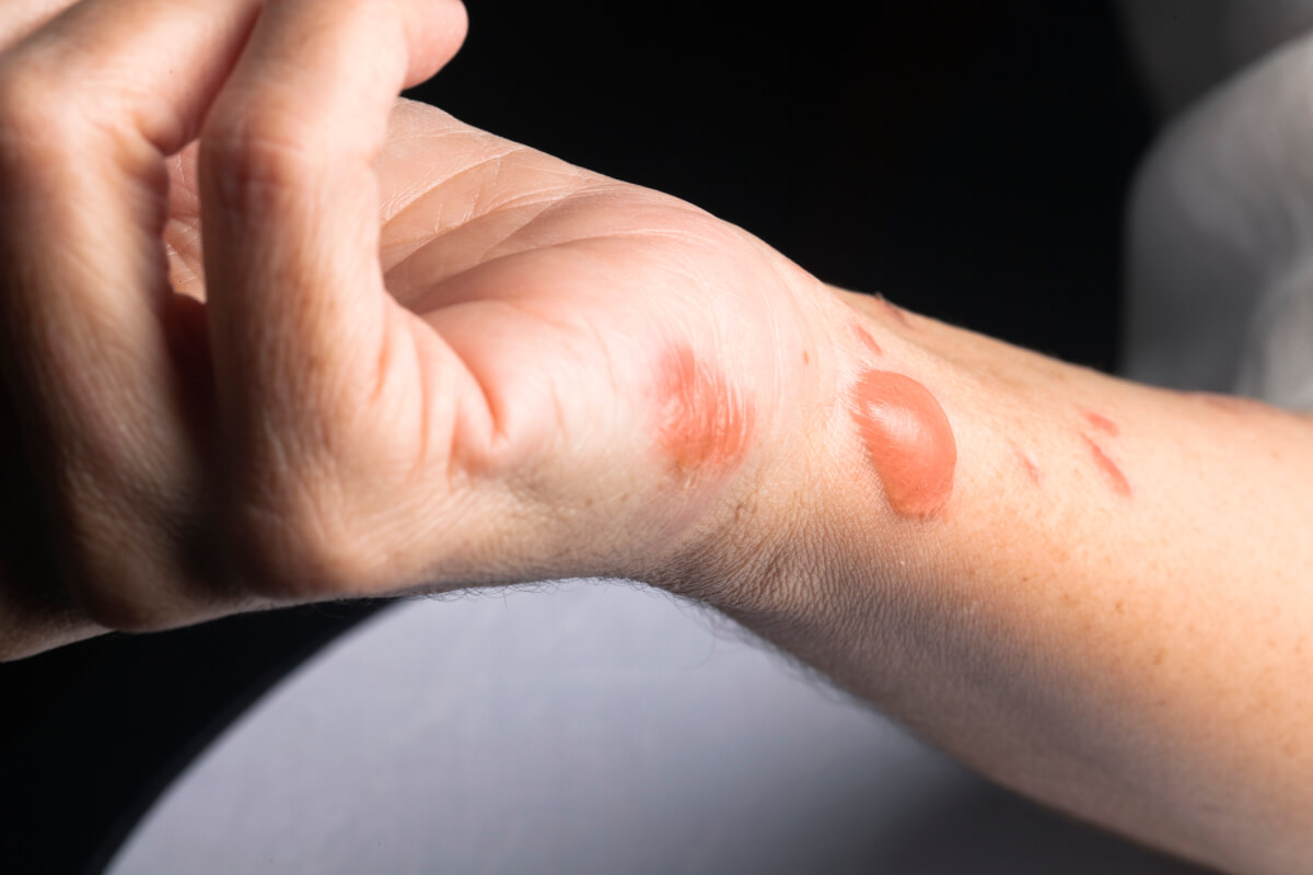 Hot Spot Healing: How to Treat Minor Burns