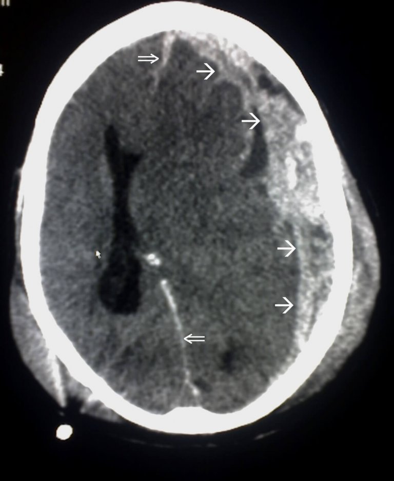Brain Quakes: What Happens During a Concussion?